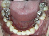 宝塚市　歯科　もり歯科クリニック　白い詰め物　インレー　症例1